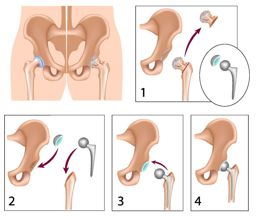 Grafik über den Einbau einer künstlichen Hüfte