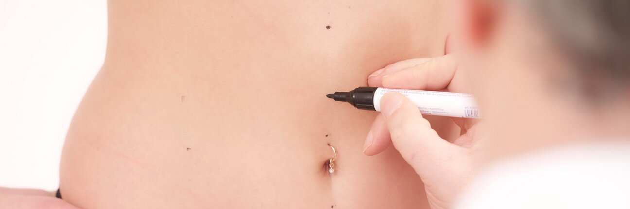 Arzt zeichnet mit einem Stift auf dem Bauch einer Dame ein 