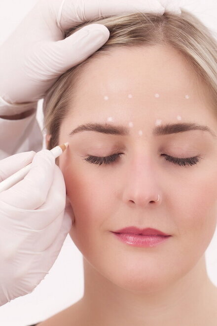Gesicht einer Frau welches mit einem weißen Stift punktuell markiert wird für Ihren Botox-Eingriff